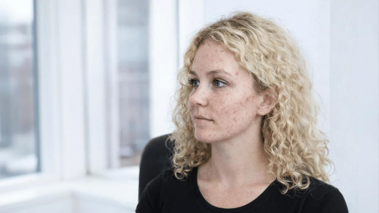 Ung kvinde med akne, til behandling hos WP Cosmetic